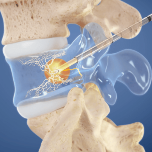 Chronic back pain treatment blocks nerve signals with heat