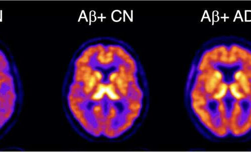 Novel PET imaging agent detects earliest signs of Alzheimer’s disease