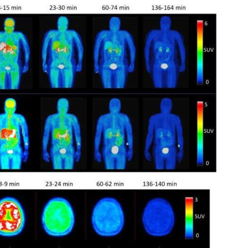 Radiotracer that detects important contributor to neurological diseases is tested for the first time in humans