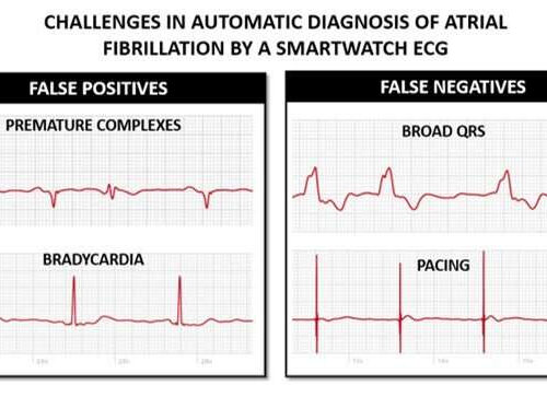 Are smartwatch health apps to detect atrial fibrillation smart enough?