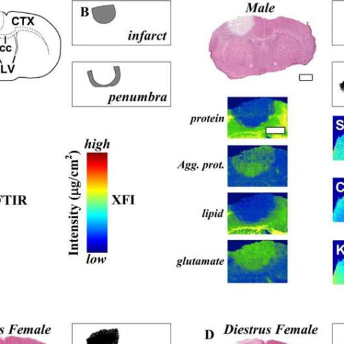 Brain differences in men and women could affect post-stroke outcomes