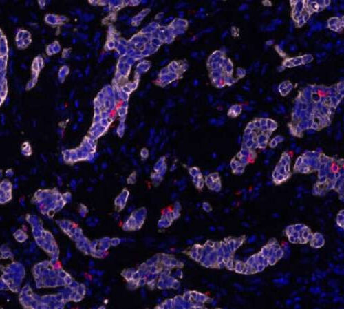 Study opens route to overcoming drug resistance in stomach cancer