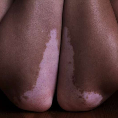 A new treatment is restoring skin coloration to some with vitiligo