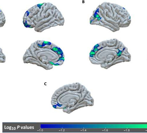 Early deprivation continues to affect brain development well into adolescence, researchers find