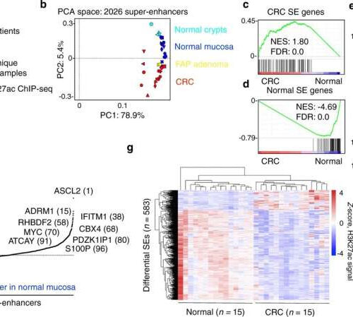 Study identifies new gene that drives colon cancer