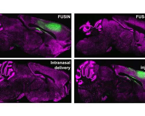 A sound approach for effective gene therapy delivery to the brain