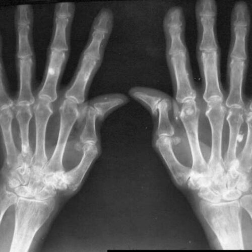 Novel study identifies key molecular players in rheumatoid arthritis