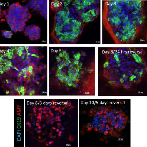 Two drugs reverse a key pancreatic cancer step in the lab