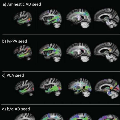 A telltale protein spreads throughout the brain in distinct patterns based on patients’ Alzheimer’s phenotype