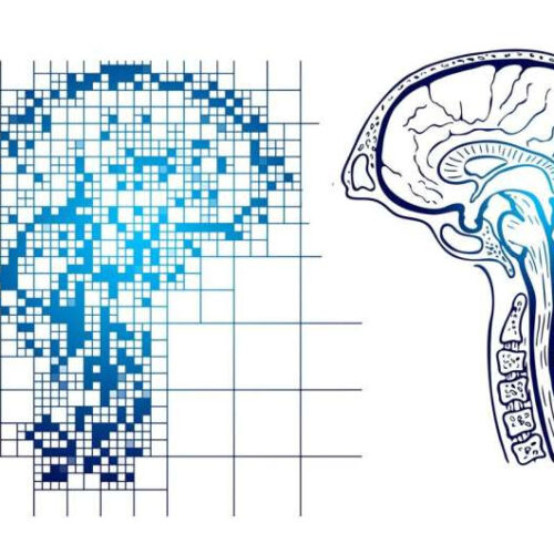 Model demonstrates how RNA splicing defects contribute to Alzheimer’s disease