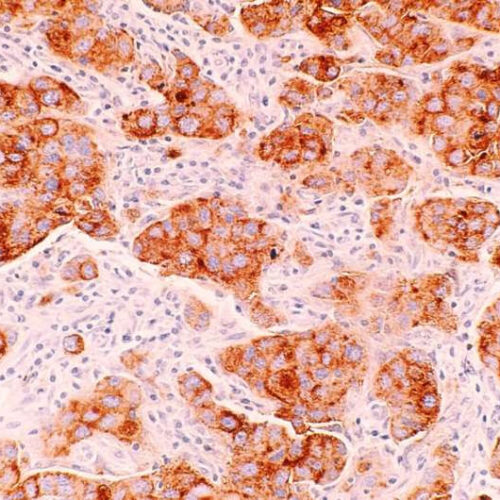 Scientists pinpoint druggable target in aggressive breast cancer