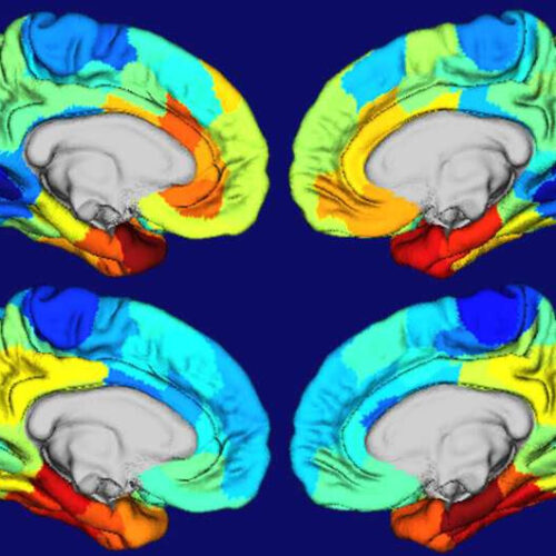 Study yields clues as to why Alzheimer’s disease damages certain parts of the brain