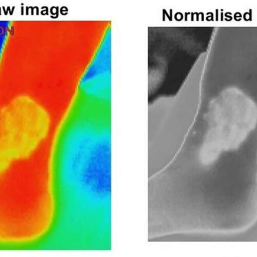 Contactless screening tool could revolutionize chronic wound treatment