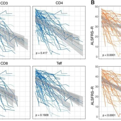 Immune cells in ALS patients can predict the course of the disease