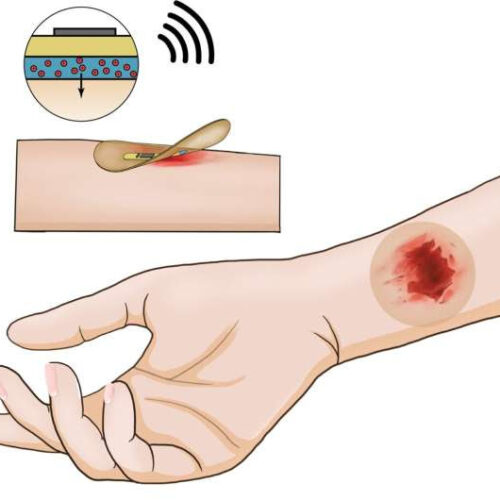 Wireless smart bandage provides new insights on healing chronic wounds