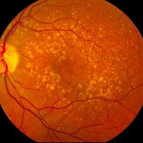 Cholesterol and diabetes drugs may lessen risk of degenerative eye disease associated with aging