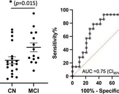 New biomarker could help diagnose Alzheimer’s disease early