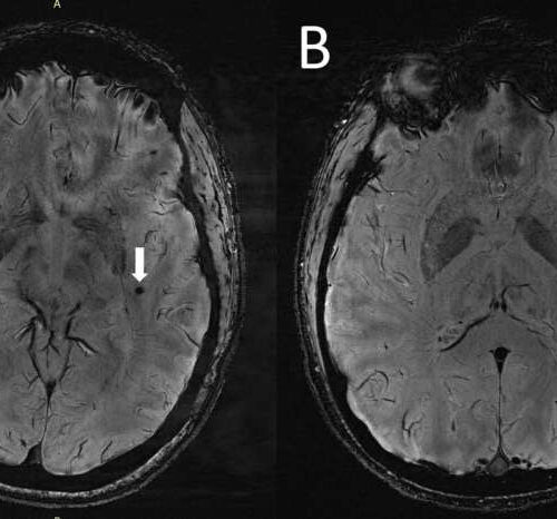 Ultra-high-resolution MRI reveals migraine brain changes