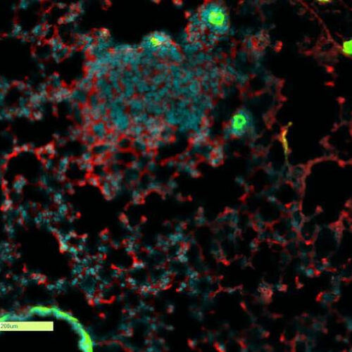 New treatment could significantly increase the efficacy of chemotherapy and prevent metastasis