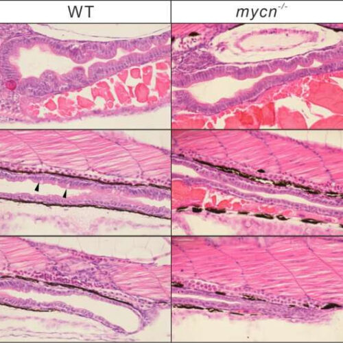 Rare human intestinal disorder is due to reduction in protein synthesis