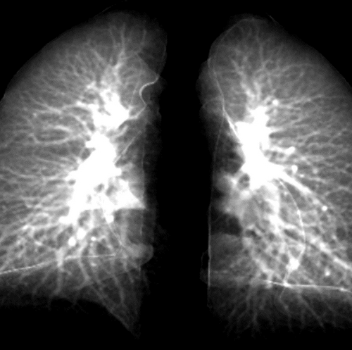 New model can detect long-COVID’s effects using simple, 2D chest X-rays