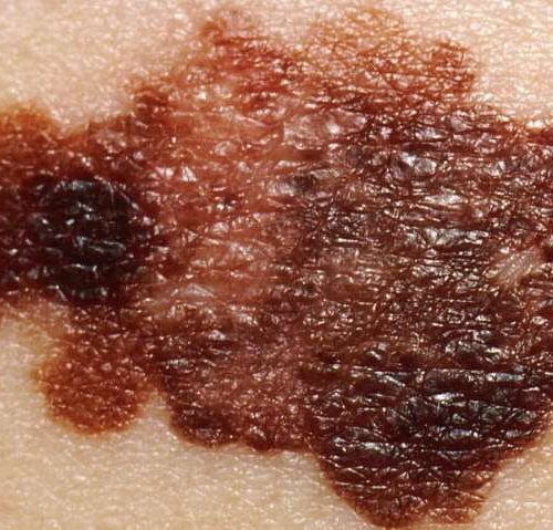 Researchers identify a subset of patients with early melanoma who face a very low risk of dying from the disease
