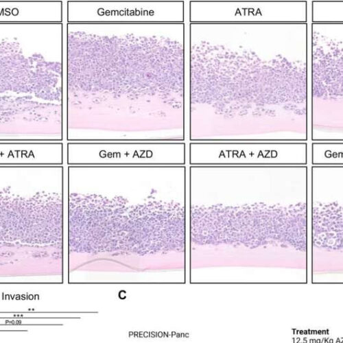 Research identifies new way to halt pancreatic cancer invasion by targeting healthy cells