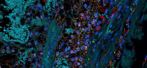 New hope for kidney cancer treatment using existing drugs