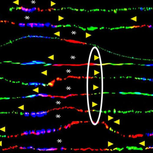 Faulty DNA repair may lead to BRCA-linked cancers