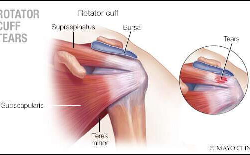 Real-world evidence study of regenerative medicine and shoulder surgery