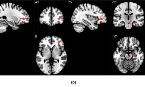 MRI reveals significant brain abnormalities post-COVID