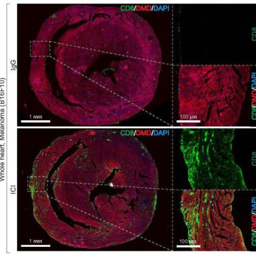 Hormone therapy could lower risk of immunotherapy-associated myocarditis in women