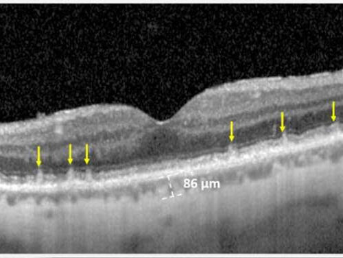 Blinding eye disease strongly associated with serious forms of cardiovascular disease