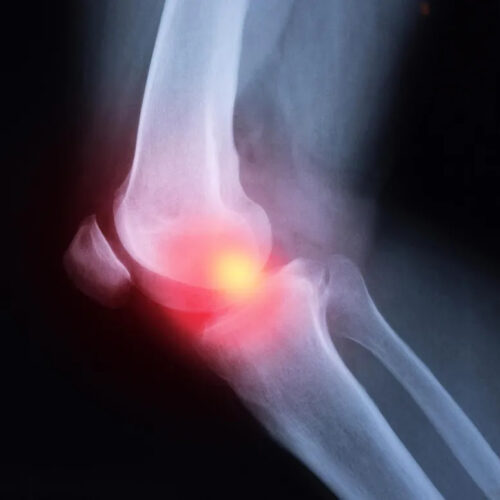 Pain Relievers Like Ibuprofen and Naproxen May Worsen Arthritis Inflammation