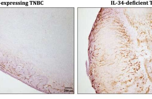 Study reveals root of triple negative breast cancer immunosuppression and chemoresistance