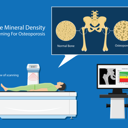 What is a Bone Density Scan (DEXA scan)?