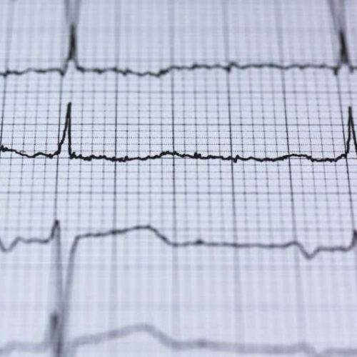 Study finds women are actually more likely than men to have AFib