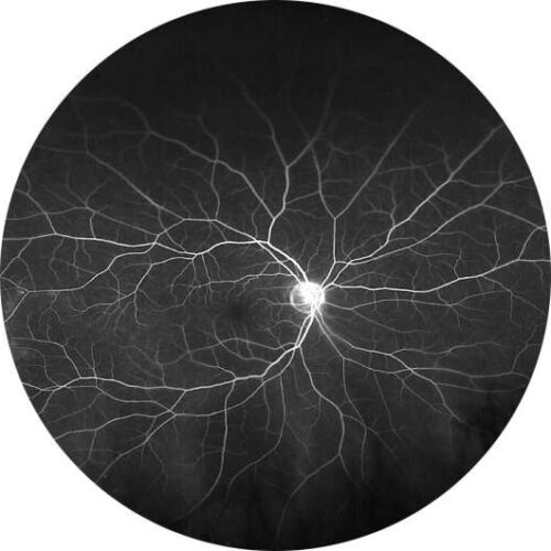 Commonly used macular degeneration drug outperforms another at weaning patients off treatment at one year