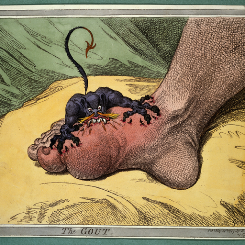 New look at an ancient disease: Study finds novel treatment targets for gout