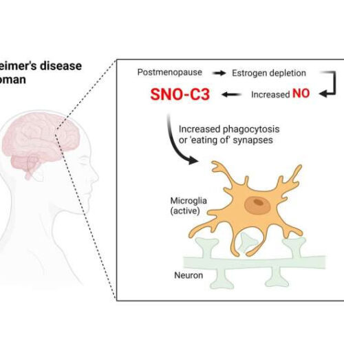 Discovery could explain why women are more likely to get Alzheimer’s