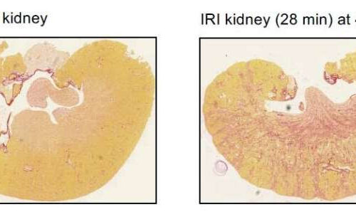 Drug discovery offers potential treatment for common kidney disease