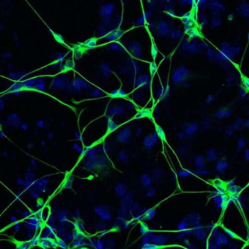 Deteriorating neurons are source of human brain inflammation in Alzheimer’s disease