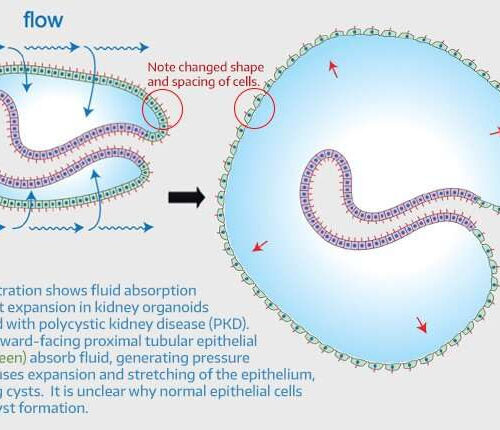 Study illuminates sugar’s role in common kidney disease