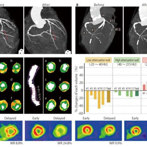 A dietary supplement leads to remarkable regression in atherosclerotic lesions