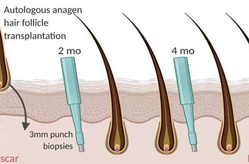 Scars mended using transplanted hair follicles in new study