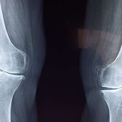 How to rewind the clock on arthritic cartilage