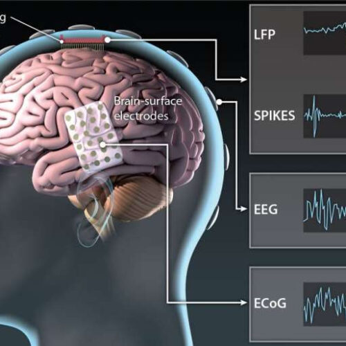 Neural prosthesis uses brain activity to decode speech