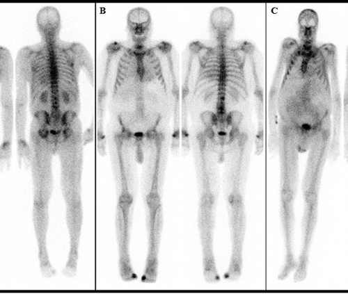 Nuclear medicine bone scan study identifies prevalence and outcomes of cardiac amyloidosis