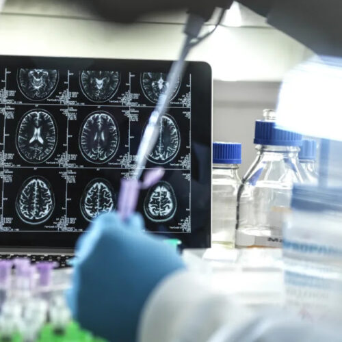 Researchers develop blood test that can reliably detect Alzheimer’s disease