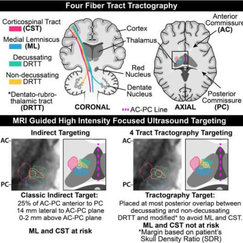 New technique improves high-intensity focused ultrasound treatment for brain disorders